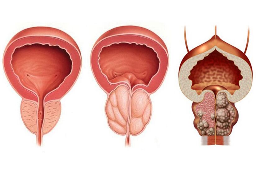 fáze prostatitidy a potřeba plně používat prostavit